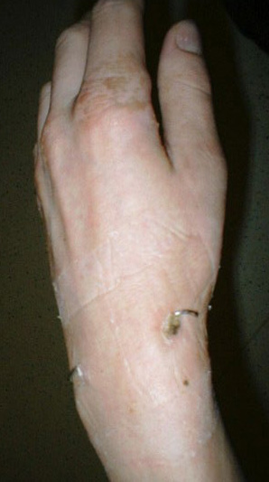 The wrist in question